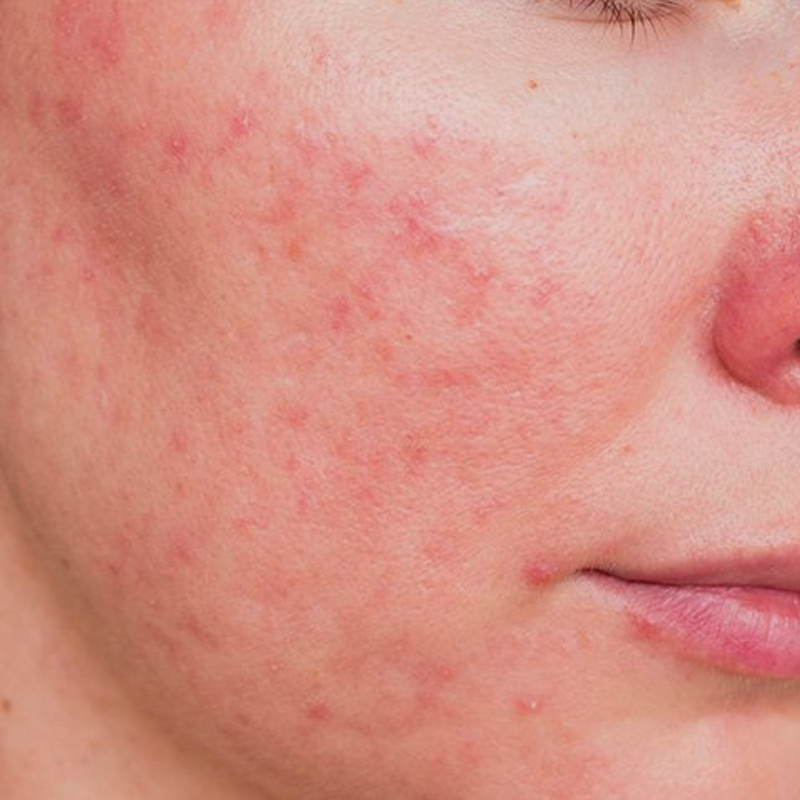 Rosacea