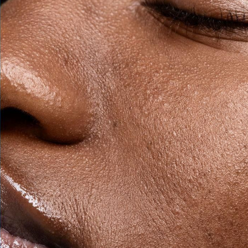 Dry Skin
