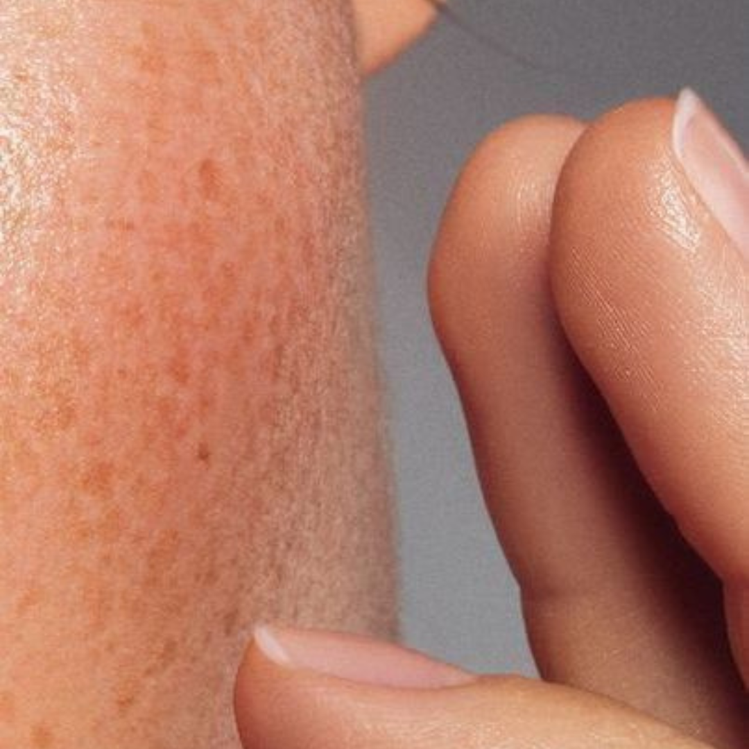 Sensitive Skin